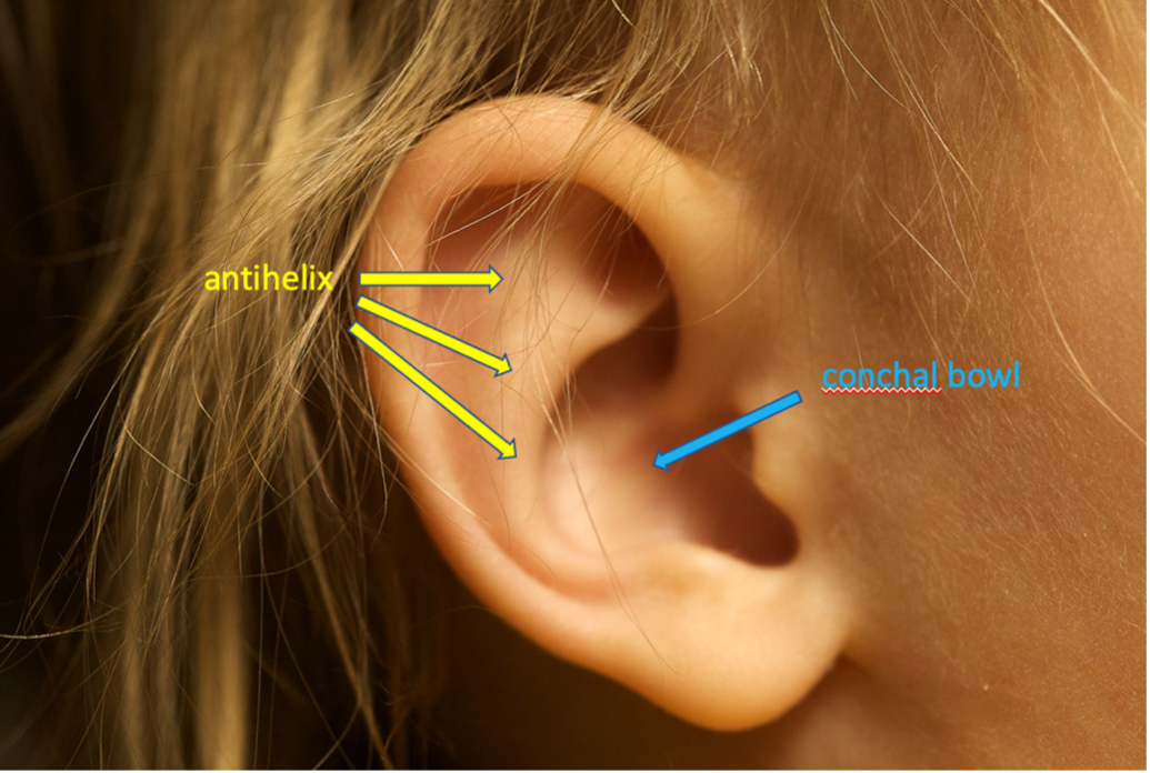 Diagram showing the anatomy of a protruding ear, including a missing antihelical fold